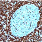 Staining with Mouse Monoclonal BCL-2 [Clone 124] Antibody in formalin-fixed paraffin-embedded human non-Hodgkins Lymphoma. Note cytoplasmic and nuclear membrane staining.