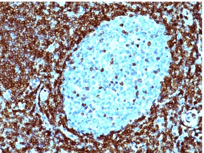 Staining with Mouse Monoclonal BCL-2 [Clone 124] Antibody in formalin-fixed paraffin-embedded human non-Hodgkins Lymphoma. Note cytoplasmic and nuclear membrane staining.