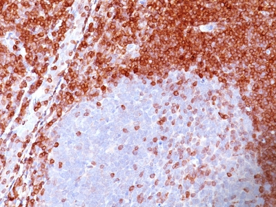 BCL-2 IHC Antibody in non-Hodgkin's Lymphoma