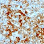 Formalin-fixed, paraffin-embedded human Renal Cell Carcinoma stained with KSP-Cadherin Monoclonal Antibody (SPM594)