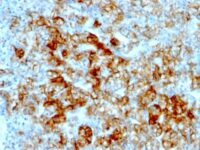 Formalin-fixed, paraffin-embedded human Renal Cell Carcinoma stained with KSP-Cadherin Monoclonal Antibody (SPM594)