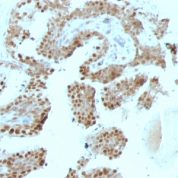 Formalin-fixed, paraffin-embedded human Prostate Carcinoma stained with p57 Monoclonal Antibody (SPM38).
