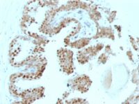 Formalin-fixed, paraffin-embedded human Prostate Carcinoma stained with p57 Monoclonal Antibody (SPM38).