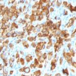 Staining by anti-MART-1 / Melan-A / MLANA Antibody 1