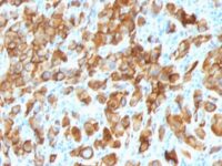 Staining by anti-MART-1 / Melan-A / MLANA Antibody 1