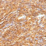 Formalin-fixed, paraffin-embedded human GIST stained with DOG-1 Monoclonal Antibody (DG1/1484).