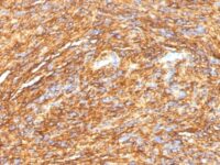 Formalin-fixed, paraffin-embedded human GIST stained with DOG-1 Monoclonal Antibody (DG1/1484).