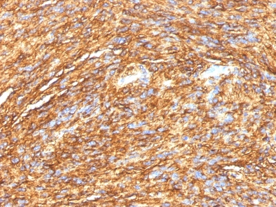 Formalin-fixed, paraffin-embedded human GIST stained with DOG-1 Monoclonal Antibody (DG1/1484).