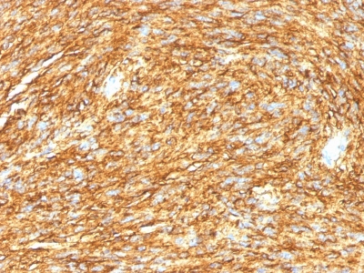 Formalin-fixed, paraffin-embedded human GIST stained with DOG-1 Monoclonal Antibody (DG1/1485).