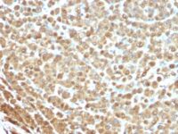 Formalin-fixed, paraffin-embedded human Melanoma stained with S1A Mouse Monoclonal Antibody (S1/61)