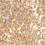 Formalin-fixed, paraffin-embedded human Lymphoma stained with CD2 Monoclonal Antibody (SPM494)