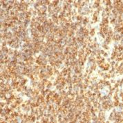 Formalin-fixed, paraffin-embedded human Lymphoma stained with CD2 Monoclonal Antibody (SPM494)