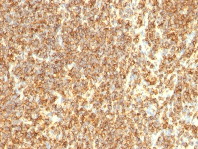 Formalin-fixed, paraffin-embedded human Lymphoma stained with CD2 Monoclonal Antibody (SPM494)