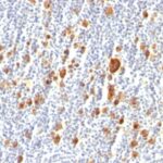 Formalin-fixed, paraffin-embedded human Hodgkins Lymphoma stained with CD3 Monoclonal Antibody (Ber-H2).