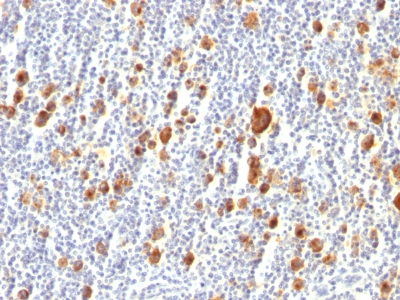 Formalin-fixed, paraffin-embedded human Hodgkins Lymphoma stained with CD3 Monoclonal Antibody (Ber-H2).