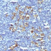 Formalin-fixed, paraffin-embedded human Hodgkins Lymphoma stained with CD3 Monoclonal Antibody (SPM121).