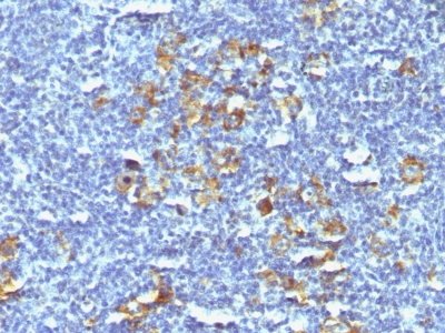 Formalin-fixed, paraffin-embedded human Hodgkins Lymphoma stained with CD3 Monoclonal Antibody (SPM121).