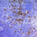 Formalin-fixed, paraffin-embedded human Hodgkins Lymphoma stained with CD3 Monoclonal Antibody (Ber-H2 + CD3/412).