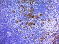 Formalin-fixed, paraffin-embedded human Hodgkins Lymphoma stained with CD3 Monoclonal Antibody (Ber-H2 + CD3/412).