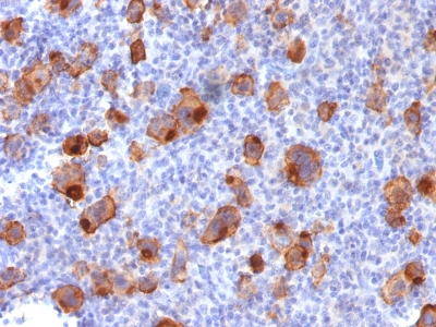 Formalin-fixed, paraffin-embedded human Hodgkins Lymphoma stained with CD3 Recombinant Rabbit Monoclonal Antibody (Ki-1/1747R).