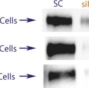 Western blot data demonstrating successful knockdown of ErbB2 / Her2 by QX19.  Knockdown of protein greater than 70% relative to control in ErbB2 / Her2 overexpressing SKBR3 and BT474 cells  and wild type MCF7 cells (97% efficiency in MCF-7 cells) (SC = Scrambled Control (Product Number QC1), siRNA = QX19 treatment)