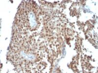 Formalin-fixed, paraffin-embedded human Colon Carcinoma stained with p21 Monoclonal Antibody (SPM36).