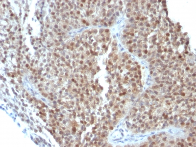 Formalin-fixed, paraffin-embedded human Bladder Carcinoma stained with p21 Monoclonal Antibody (CIP1/823 + DCS-6.2).