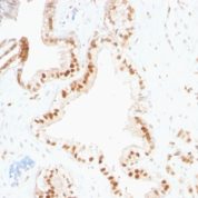 Formalin-fixed, paraffin-embedded human Prostate Carcinoma stained with p27 Monoclonal Antibody (SPM348)