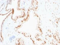 Formalin-fixed, paraffin-embedded human Prostate Carcinoma stained with p27 Monoclonal Antibody (SPM348)