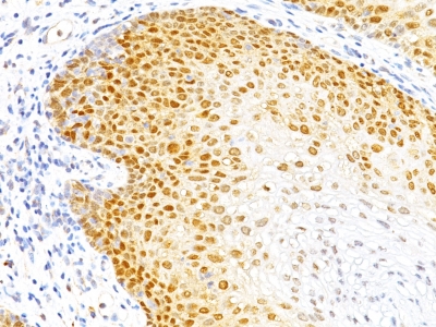 Formalin-fixed, paraffin-embedded human Colon Carcinoma stained with p27 Monoclonal Antibody (DCS-72.F6)