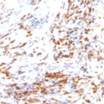 Formalin-fixed, paraffin-embedded human Colon Carcinoma stained with p27 Monoclonal Antibody (DCS-72.F6 + KIP1/769)