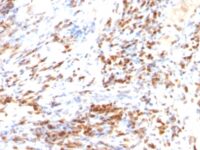 Formalin-fixed, paraffin-embedded human Colon Carcinoma stained with p27 Monoclonal Antibody (DCS-72.F6 + KIP1/769)