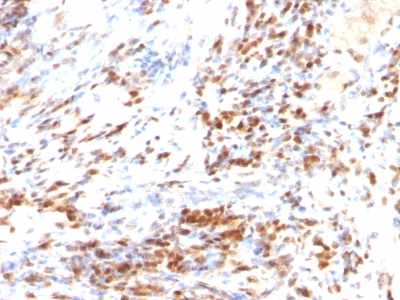 Formalin-fixed, paraffin-embedded human Colon Carcinoma stained with p27 Monoclonal Antibody (DCS-72.F6 + KIP1/769)