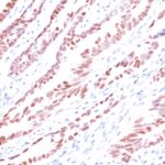 Formalin-fixed, paraffin-embedded human Colon Carcinoma stained with p57 Monoclonal Antibody (KP1).