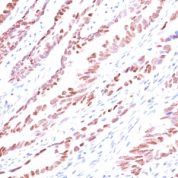 Formalin-fixed, paraffin-embedded human Colon Carcinoma stained with p57 Monoclonal Antibody (KP1).
