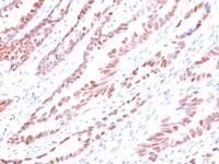 Formalin-fixed, paraffin-embedded human Colon Carcinoma stained with p57 Monoclonal Antibody (KP1).