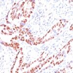 Formalin-fixed, paraffin-embedded human Prostate Carcinoma stained with p57 Monoclonal Antibody (KIP2/88).