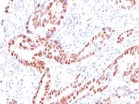 Formalin-fixed, paraffin-embedded human Prostate Carcinoma stained with p57 Monoclonal Antibody (KIP2/88).