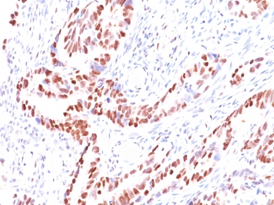 Formalin-fixed, paraffin-embedded human Prostate Carcinoma stained with p57 Monoclonal Antibody (KIP2/88).