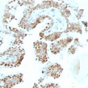 Formalin-fixed, paraffin-embedded human Prostate Carcinoma stained with p57 Monoclonal Antibody (KP1+KIP2/88).