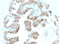 Formalin-fixed, paraffin-embedded human Prostate Carcinoma stained with p57 Monoclonal Antibody (KP1+KIP2/88).