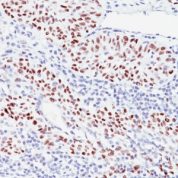 Formalin-fixed, paraffin-embedded human Bladder Carcinoma stained with p57 Monoclonal Antibody (57P6).