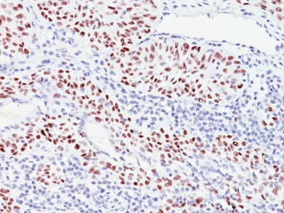 Formalin-fixed, paraffin-embedded human Bladder Carcinoma stained with p57 Monoclonal Antibody (57P6).