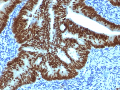 Formalin-fixed, paraffin-embedded Human Colon Carcinoma stained with CDX2 Mouse Monoclonal Antibody (CDX2/169).