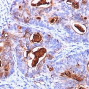 Formalin-fixed, paraffin-embedded human Colon Carcinoma stained with CEA Monoclonal Antibody (C66/126).