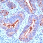 Formalin-fixed, paraffin-embedded human Colon Carcinoma stained with CEA Monoclonal Antibody (C66/195).