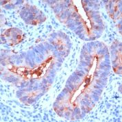 Formalin-fixed, paraffin-embedded human Colon Carcinoma stained with CEA Monoclonal Antibody (C66/195).