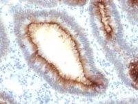 Formalin-fixed, paraffin-embedded human Colon Carcinoma stained with CEA Monoclonal Antibody (SPM33).