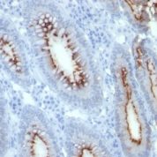 Formalin-fixed, paraffin-embedded human Colon Carcinoma stained with CEA Monoclonal Antibody (C66/261)