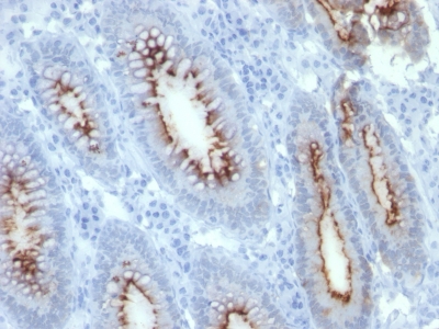 Formalin-fixed, paraffin-embedded human Colon Carcinoma stained with CEA Monoclonal Antibody (C66/261)